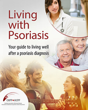living with psoriasis